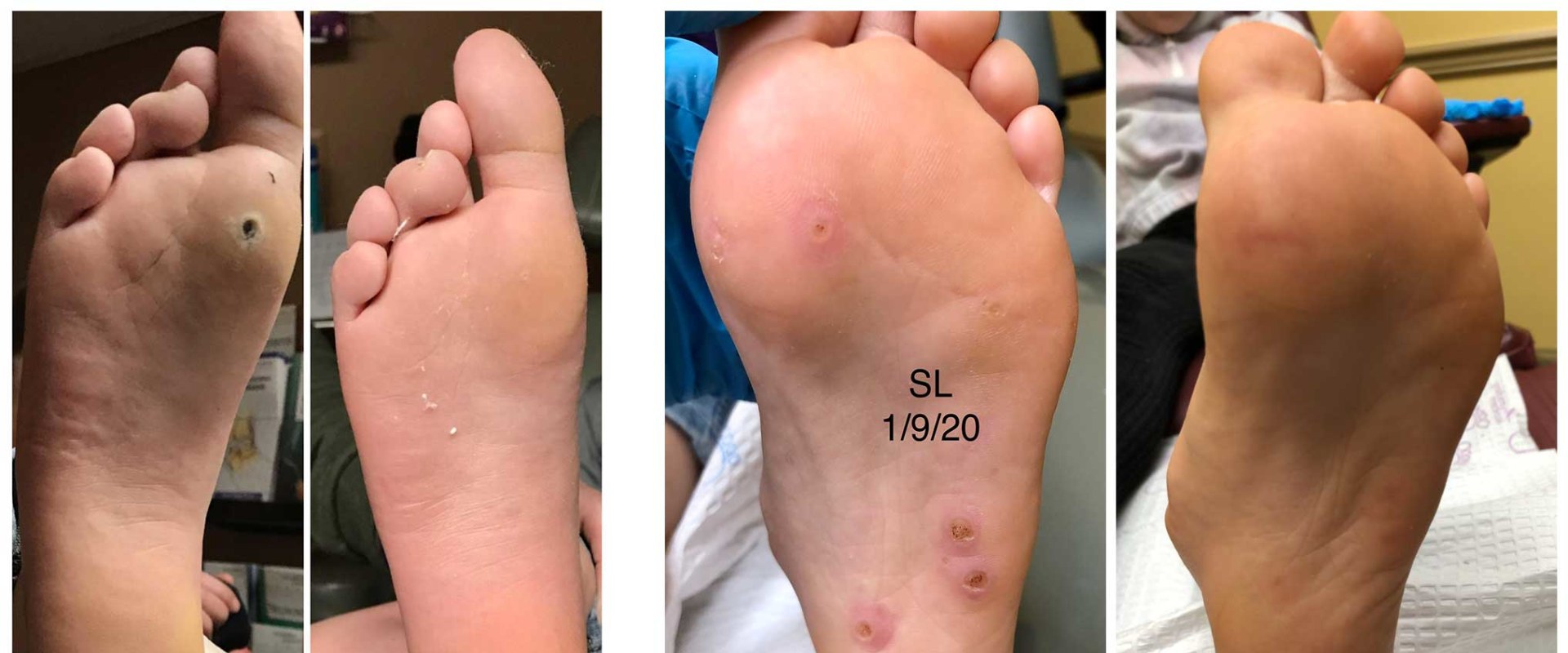 Worried About Wart Recovery? Stages of Wart Healing After Freezing Explained