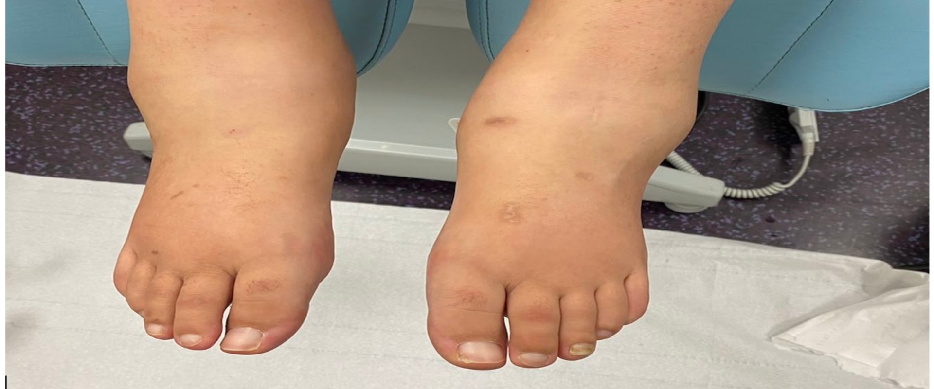 What Is Charcot Foot? Spot the Early Signs Before It’s Too Late