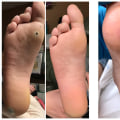 Worried About Wart Recovery? Stages of Wart Healing After Freezing Explained