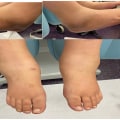 What Is Charcot Foot? Spot the Early Signs Before It’s Too Late