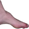Expert Insights: Managing Congenital Foot Deformities