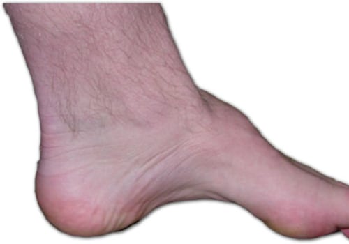 Expert Insights: Managing Congenital Foot Deformities